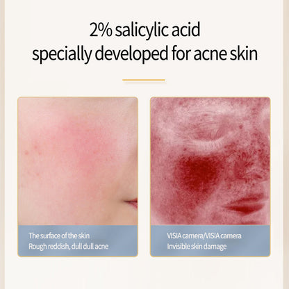 Sérum Anti-Acné à l’Acide Salicylique 2% – Résultats Rapides & Peau Purifiée